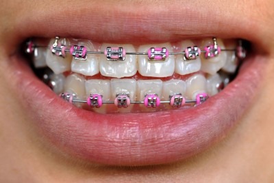 metal braces