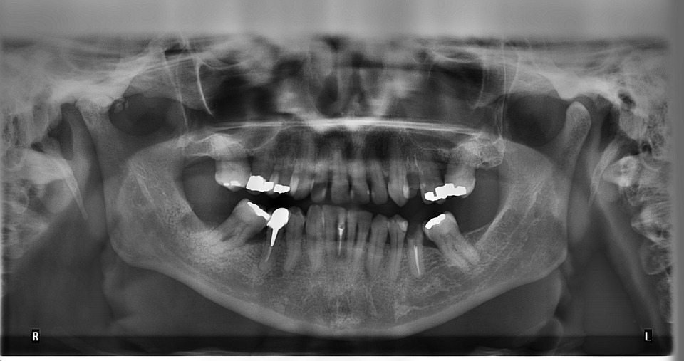 Dental X-rays and Brain Tumors: Any Relations?