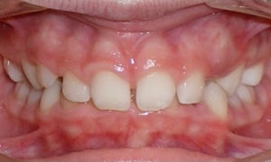 patient with spacing between the teeth and a deep bite before treatment