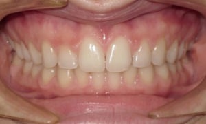 patient with spacing between the teeth and a deep bite after treatment