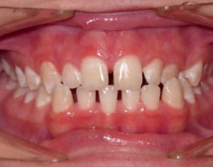 patient before being treated with invisalign