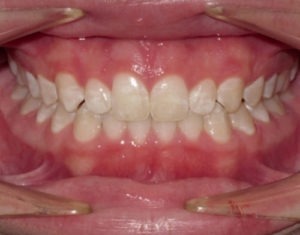 patient after being treated with invisalign
