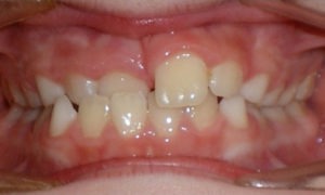 patient with a crossbite before treatment