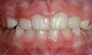 patient with a crossbite after treatment