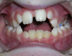 patient with open bite and crossbite before treatment