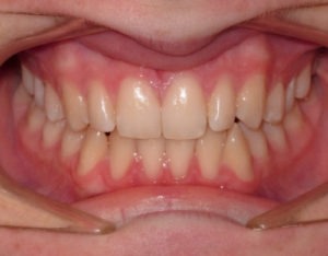 patient with open bite and crossbite after treatment