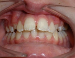 patient with front teeth stuck out before treatment