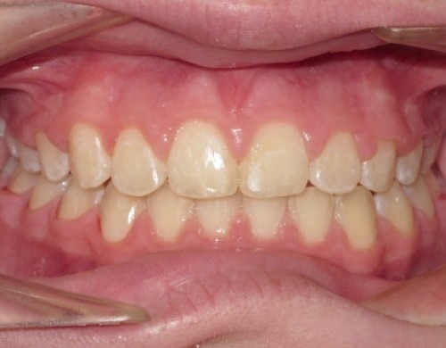 patient with front teeth stuck out after treatment