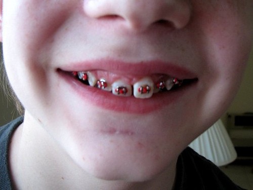 lingual braces Archives - First impression