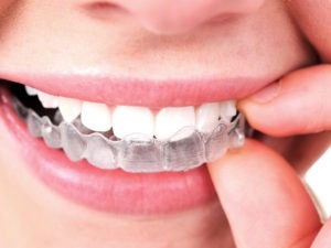 how do i clean my invisalign