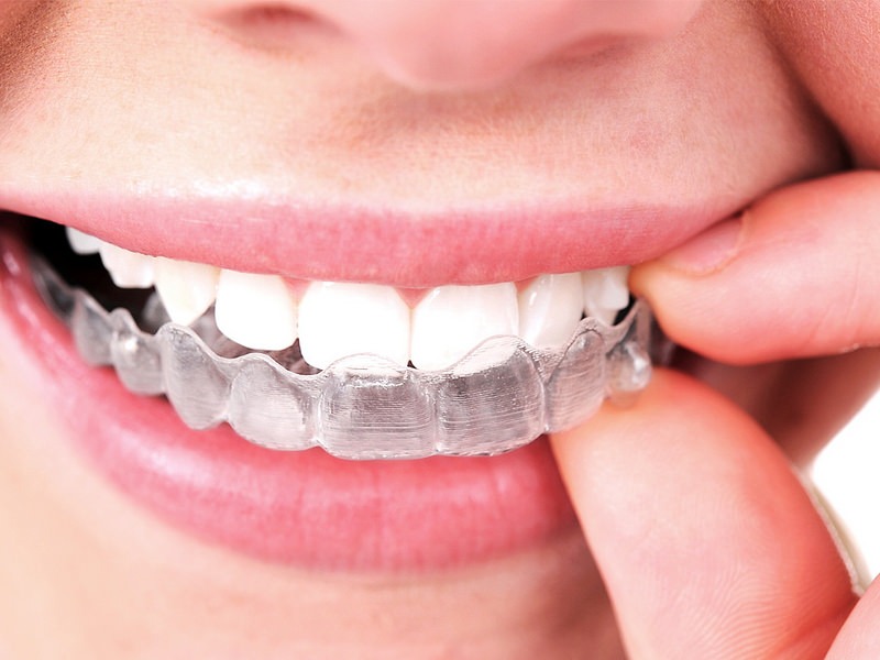 What Are the Other Options if You Don’t Want Traditional Metal Braces?