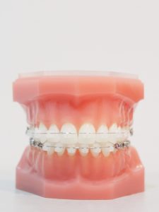 ceramic braces model