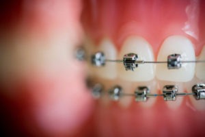 Metal braces close up