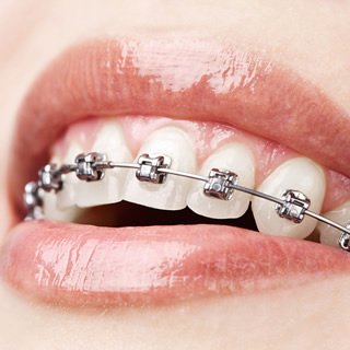 metal braces